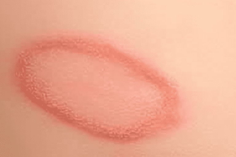 How to treat ringworm infections in BJJ